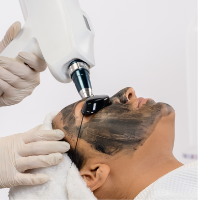 Carbon Laser Facial